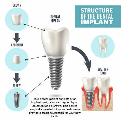 implant
